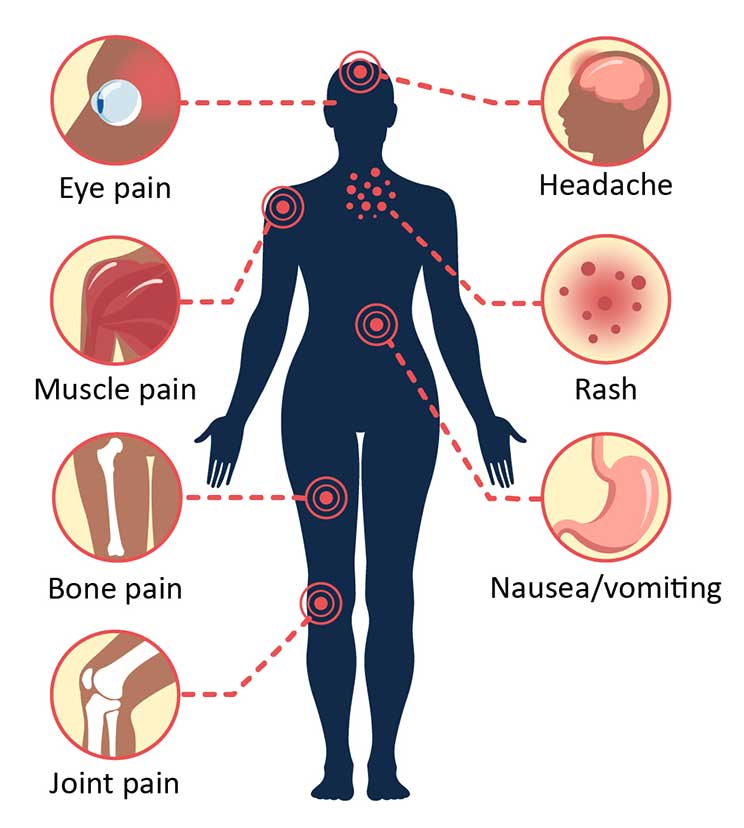 symptoms for dengue virus