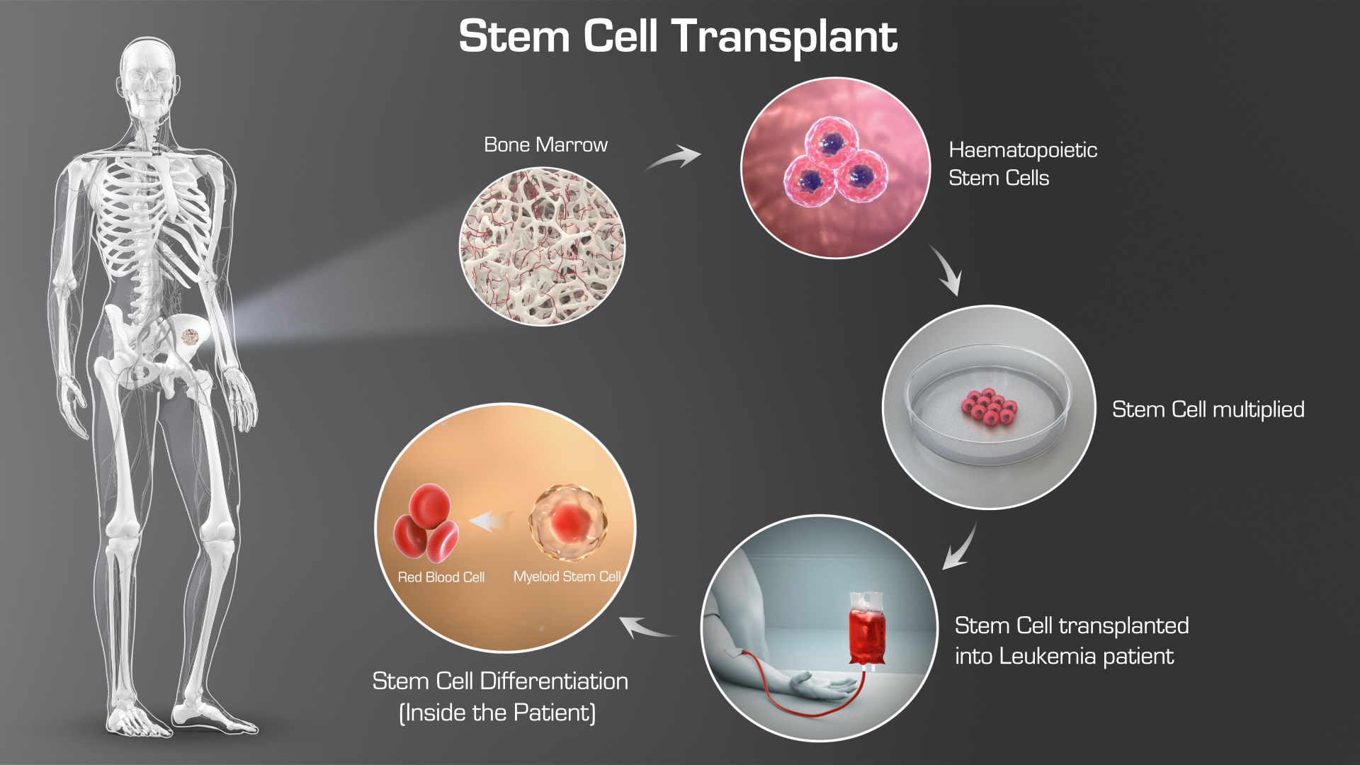 Stem Cell Transplant